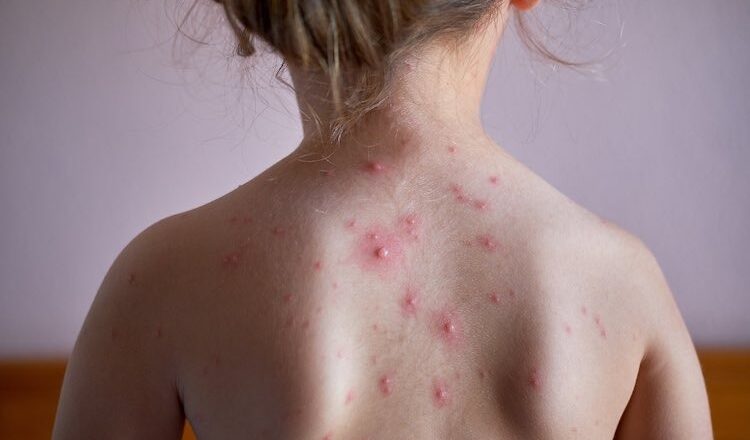 Case of chickenpox detected in Puthwari Nawgam Langate