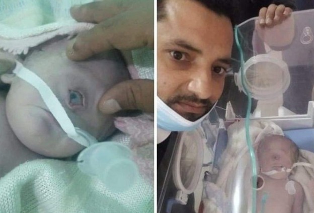 Woman gives birth to One-eyed child in Yemen