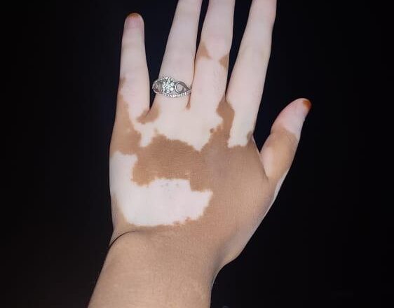 An ordeal of the Vitiligo patches and the invisible scars it leaves