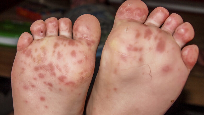 13 cases of Hand, foot and mouth disease reported in Srinagar